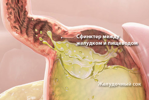 Повышенная кислотность желудочного сока как лечить Повышенная кислотность желудочного сока как лечить