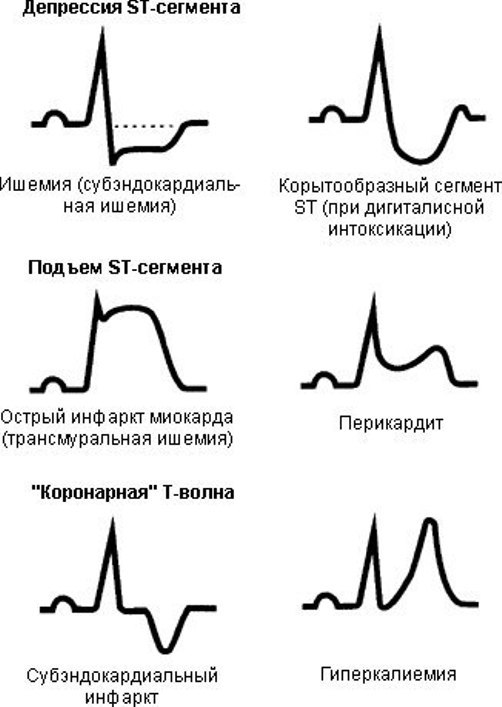 Ишемия сердца на экг в картинках