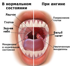 Який інкубаційний період у гнійної ангіни?