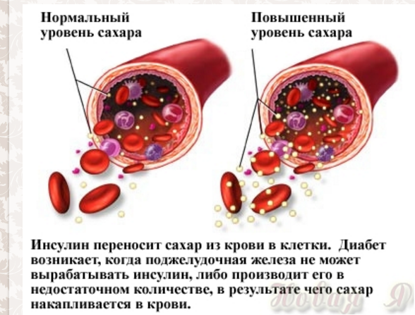 Цукровий діабет: причина виникнення і способи лікування?